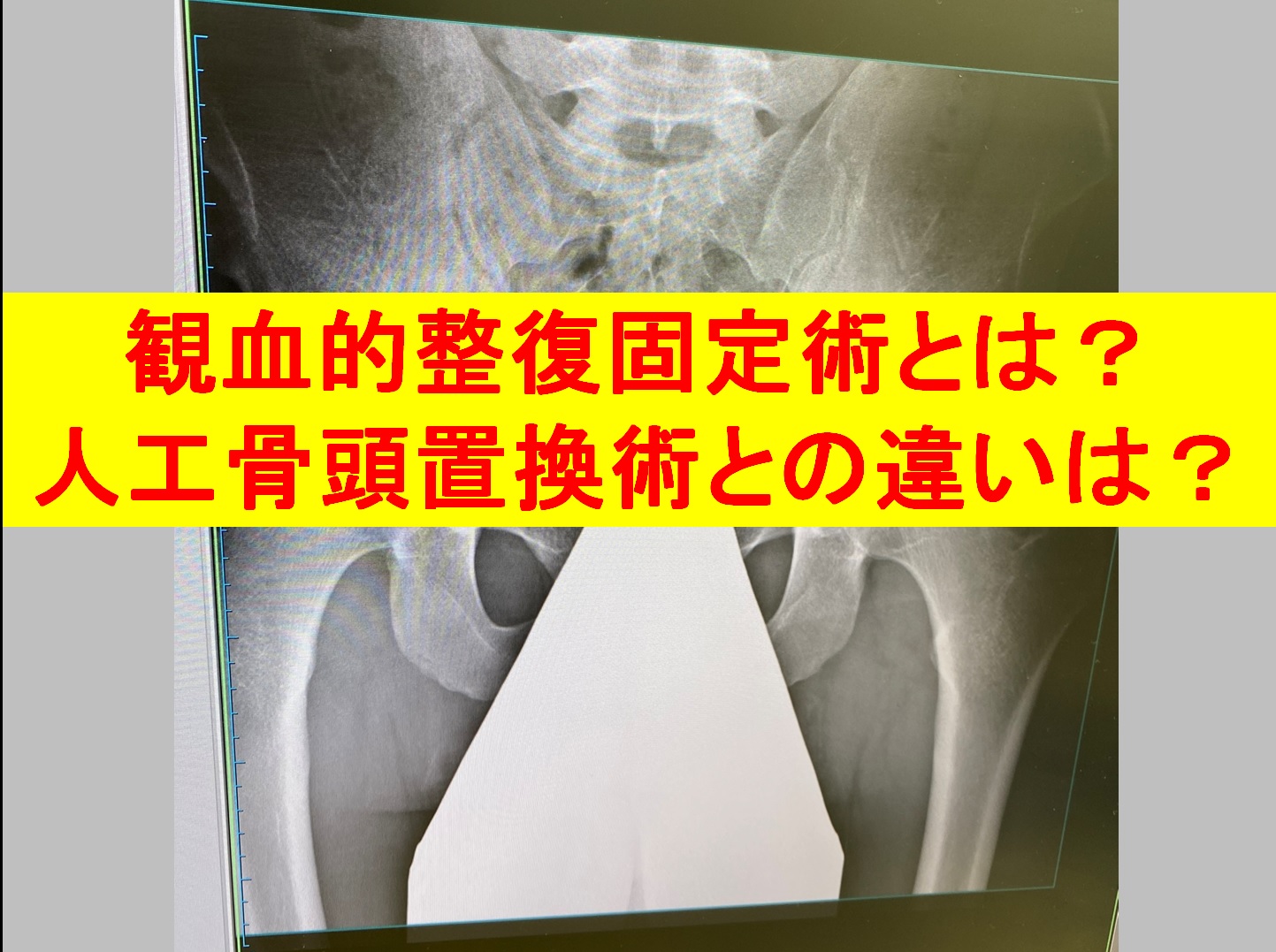 関節固定術と関節形成術の有効性